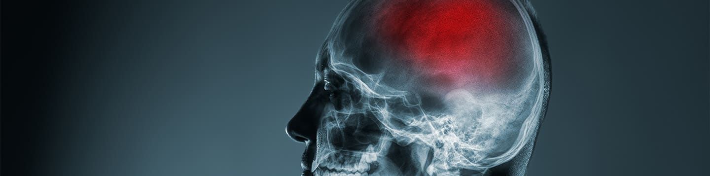 Efectos a largo plazo de las lesiones cerebrales traumáticas